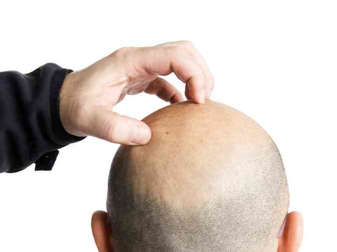 hand scratching what ppears to be male balding head